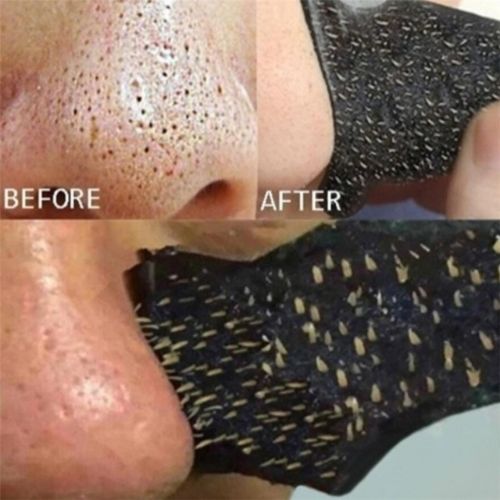 Blackhead removal strips