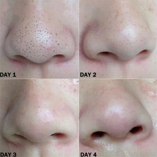 Blackhead removal strips